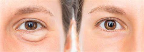 Correción de Ojeras